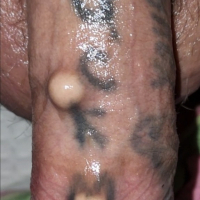 Ynkerner ovqer sirum en im margarit implantnery